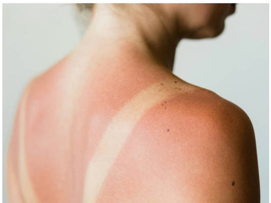 Can I Use CBD For Sunburns? - Erth Wellness